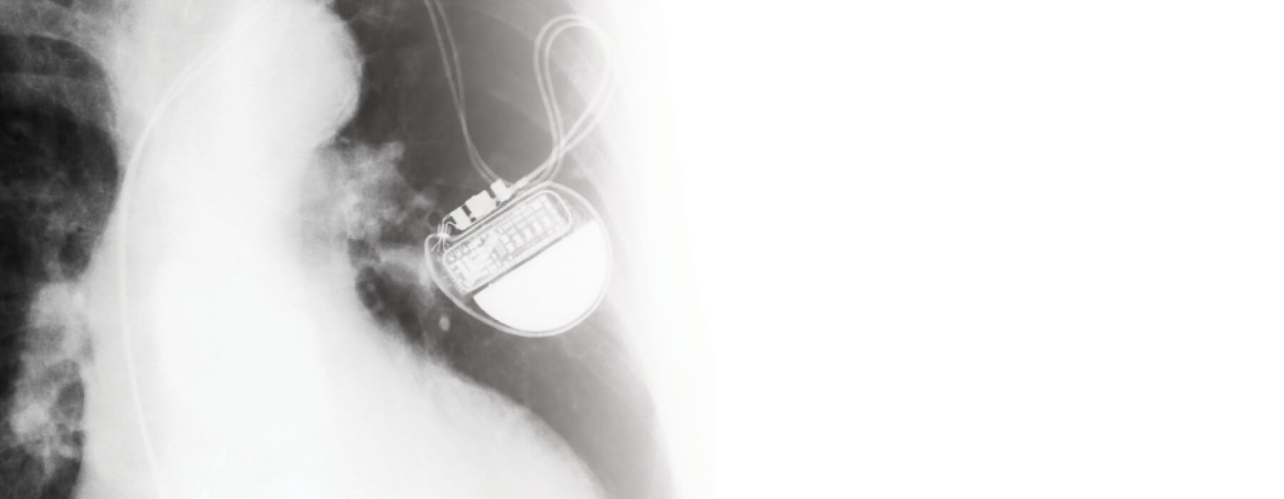 Matters of the heart: Saskatchewan patients benefit from new contracts for cardiac devices